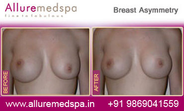 breast-asymmetry-before-and-after-gallery-mumbai-india.jpg