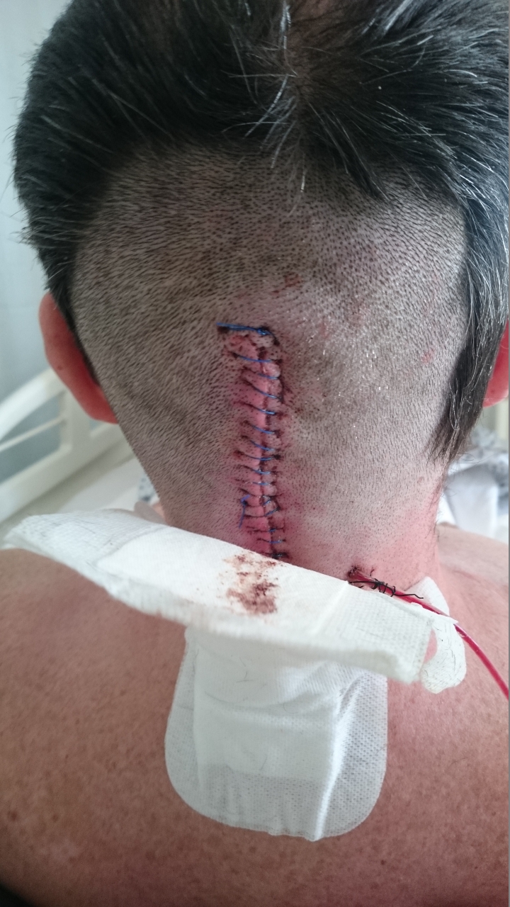 2nd operation wound