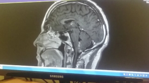 Brain Tumor 22nd feb 2017
